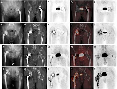 Different uptake patterns of 68Ga-FAPI in aseptic loosening and periprosthetic joint infection of hip arthroplasty: A case series and literature review